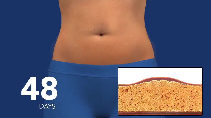 1-How-Coolsculpting-Works-38