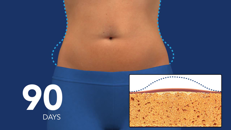 1-How-Coolsculpting-Works-39